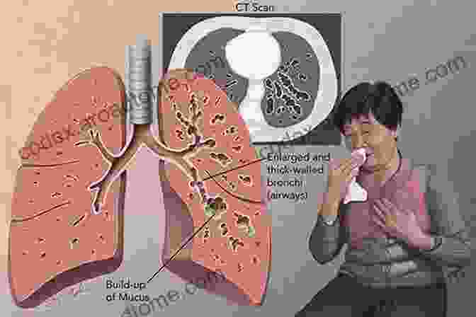 A Medical Illustration Of Bronchiectasis Showing The Dilated And Mucus Filled Airways A Simple Guide To Dilated Bronchi Mucus Blockage (Bronchiectasis) Diagnosis Treatment And Related Conditions