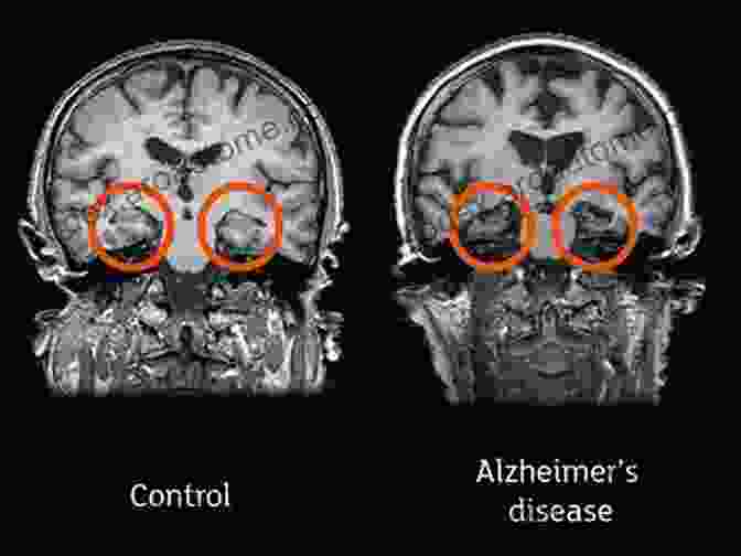 An MRI Scan Of An Alzheimer's Affected Brain, Highlighting The Accumulation Of Amyloid Plaques And Tau Tangles. TIME The Science Of Alzheimer S