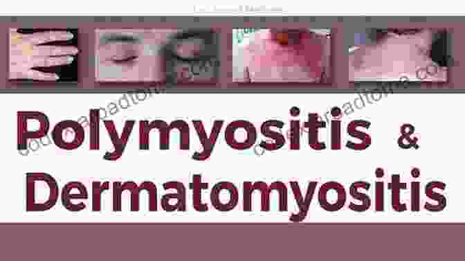 Dermatomyositis Rash A Simple Guide To Dermatomyositis Diagnosis Treatment And Related Conditions (A Simple Guide To Medical Conditions)