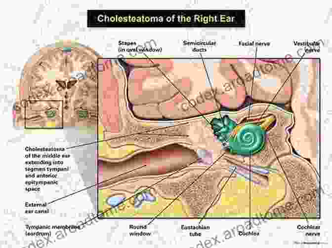 Diagram Illustrating The Location And Structure Of Cholesteatoma In The Middle Ear A Simple Guide To Cholesteatoma Diagnosis Treatment And Related Conditions