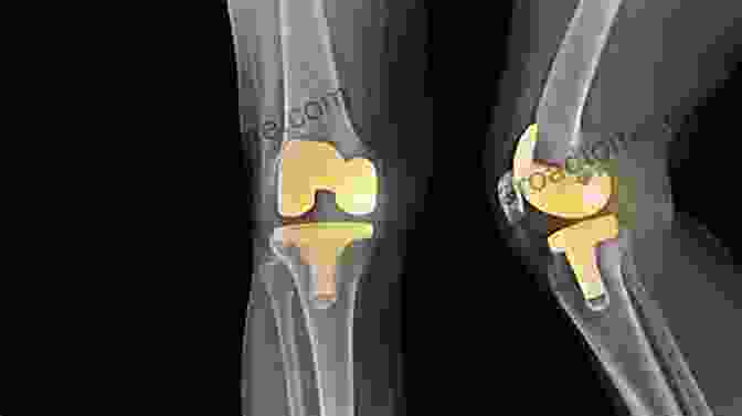 Diagram Of The Anatomy Of The Knee Joint Before And After Knee Replacement Surgery Knee Replacement 101 Richard Greene