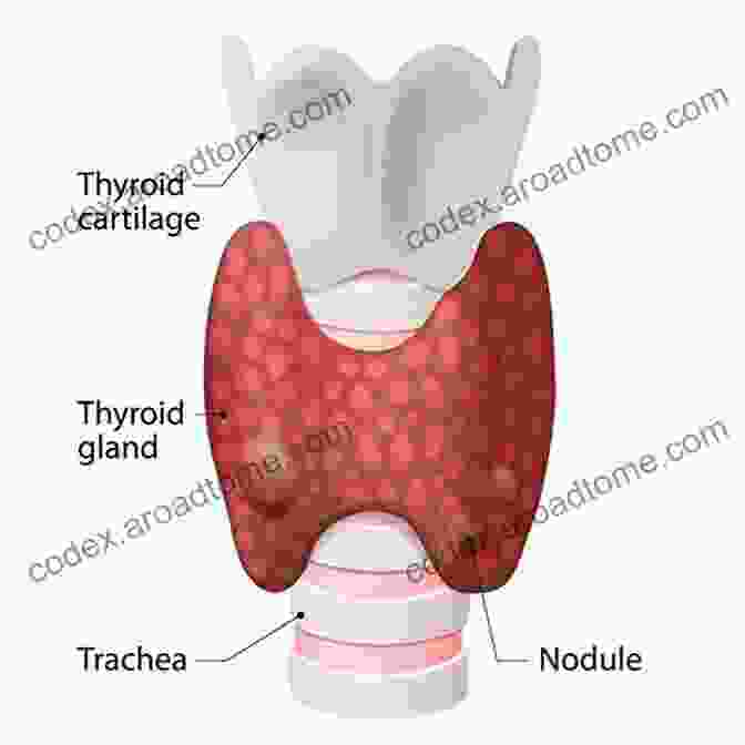 Diagram Of Thyroid Nodule Formation A Simple Guide To Thyroid Nodule Diagnosis Treatment And Related Conditions (A Simple Guide To Medical Conditions)