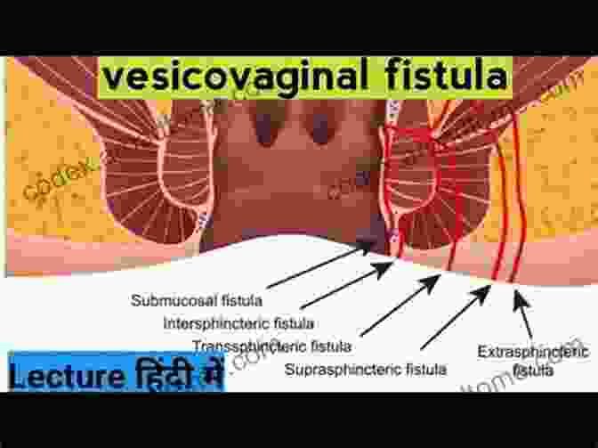 Diagram Of Vesicovaginal Fistula A Simple Guide To Vesicovaginal Fistula Diagnosis Treatment And Related Conditions (A Simple Guide To Medical Conditions)