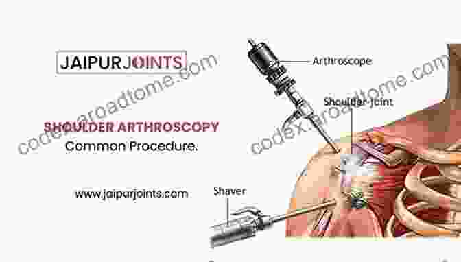 Shoulder Arthroscopic Surgery Surgical Techniques Of The Shoulder Elbow And Knee In Sports Medicine E Book: Expert Consult Online And Print