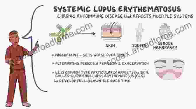 Simple Guide To Systemic Lupus Erythematosus And Related Autoimmune Diseases A Simple Guide To Systemic Lupus Erythematosis And Related Autoimmune Diseases (A Simple Guide To Medical Conditions)