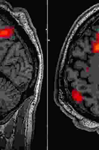 Imaging In Movement Disorders: Imaging In Movement Disorder Dementias And Rapid Eye Movement Sleep Behavior Disorder (ISSN 144)